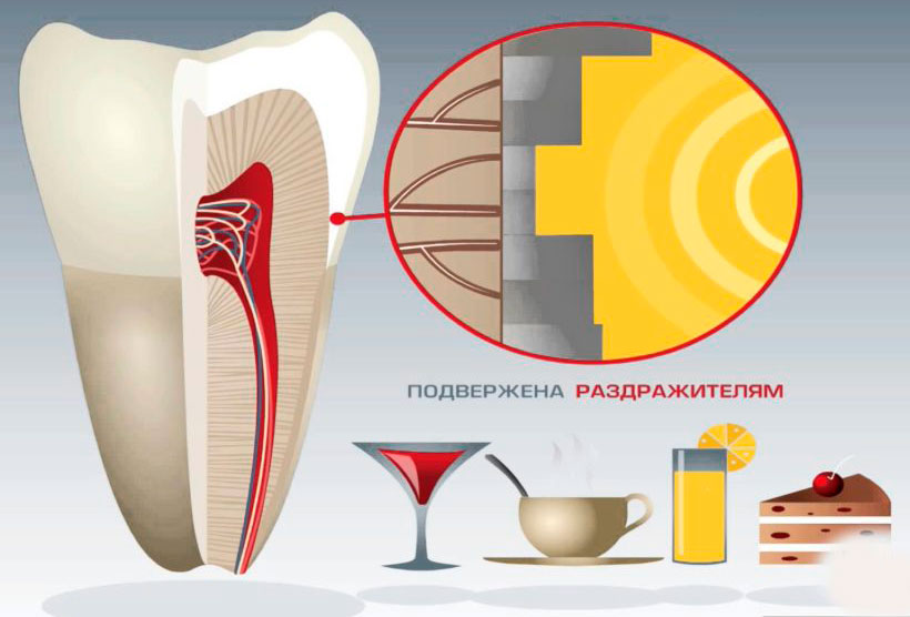 Лечение чувствительности зубов