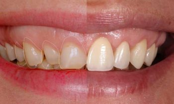 Реставрация и наращивание зубов